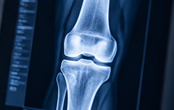 Radiografía de rodilla